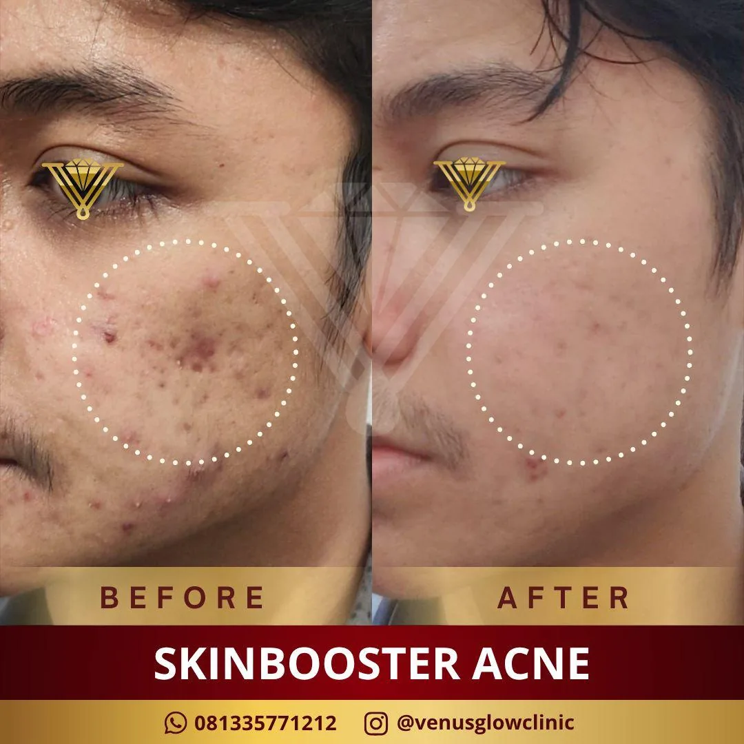 Before & after — Skinbooster — Acne