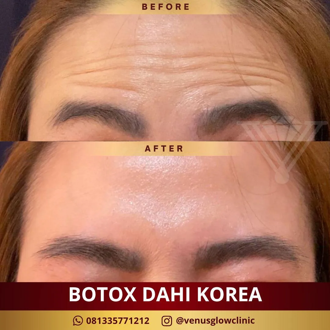 Before & after — Botox Dahi