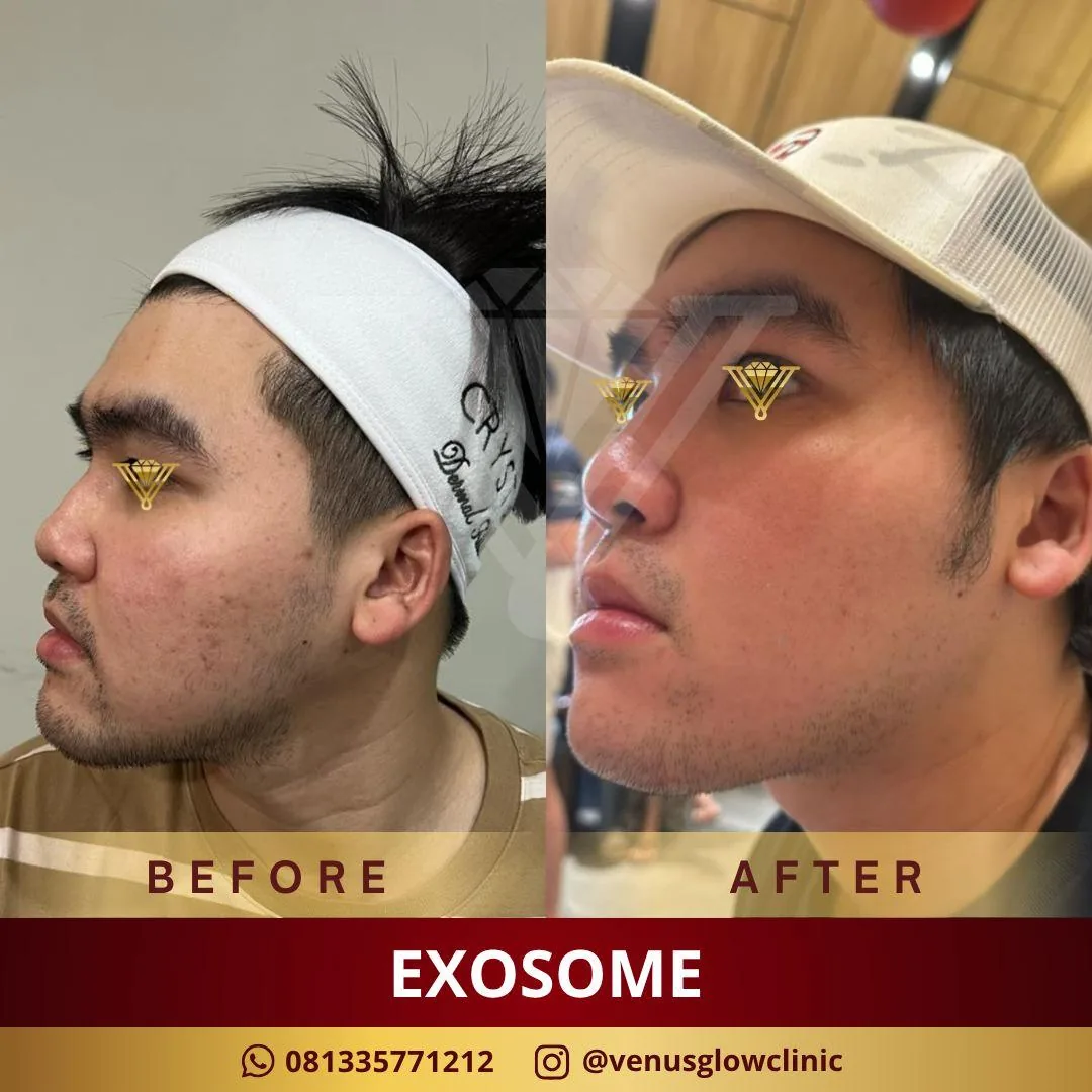 ASCE Exosome