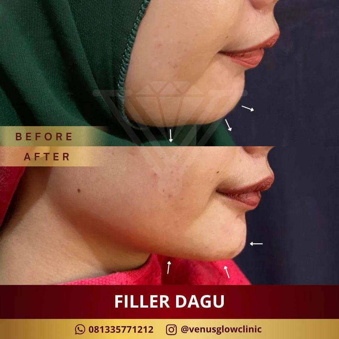 Filler Dagu (Korea)
