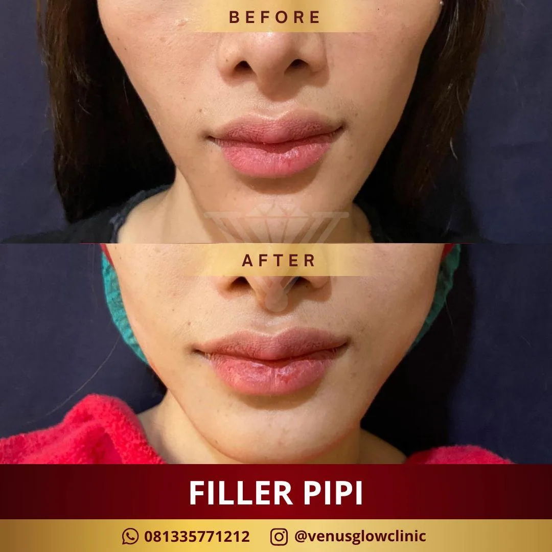 Before & after — Filler Pipi