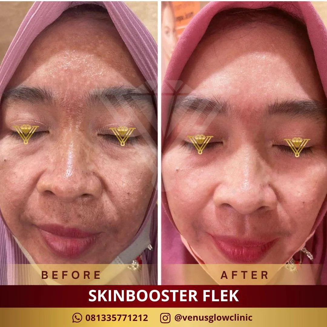 Before & after — Skinbooster — Flek