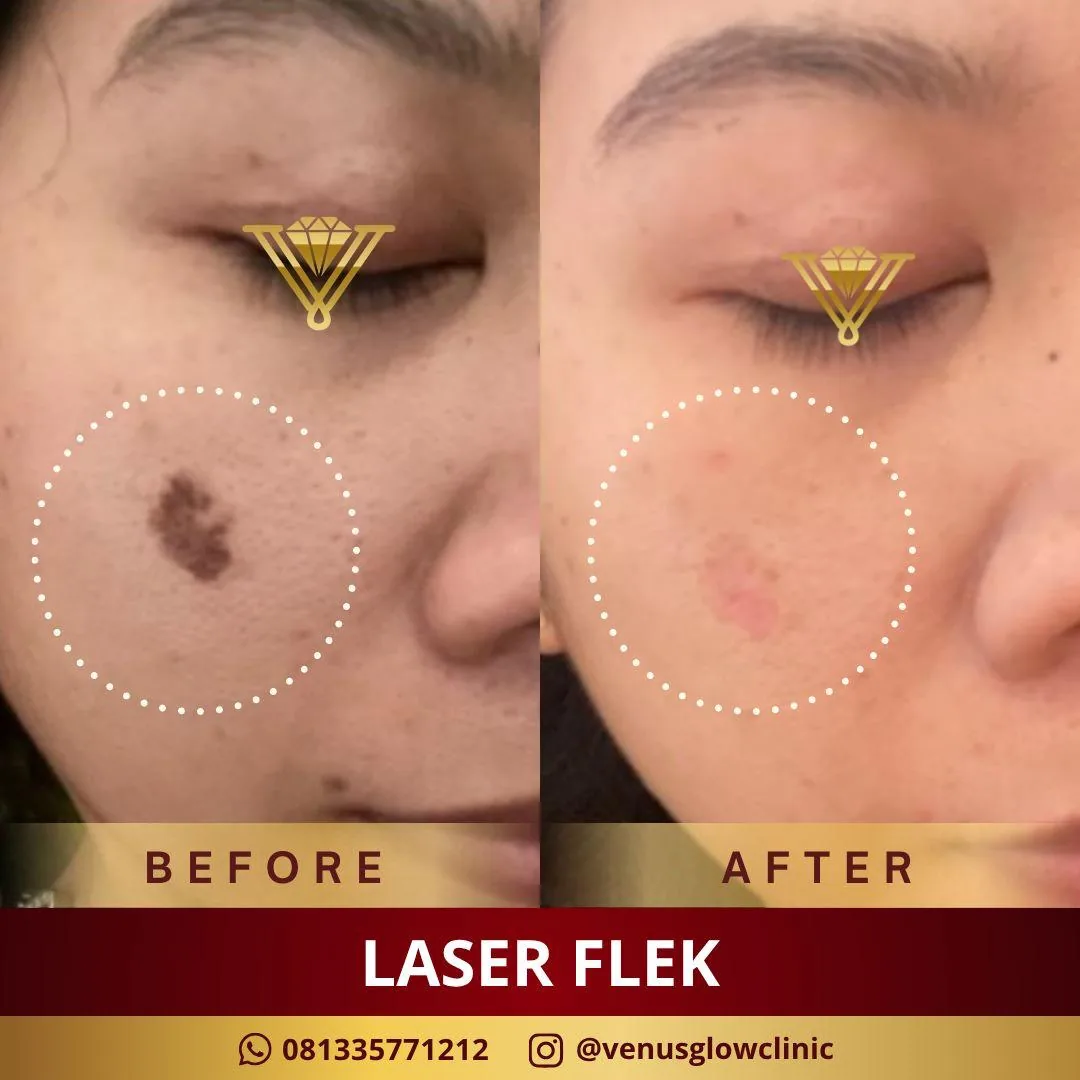 Laser Melasma / Flek