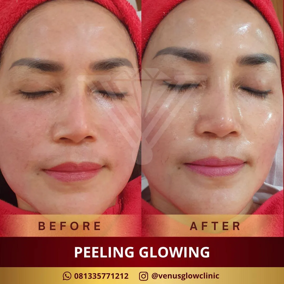 Rejuve Advance Peeling + Photo Dynamic Therapy