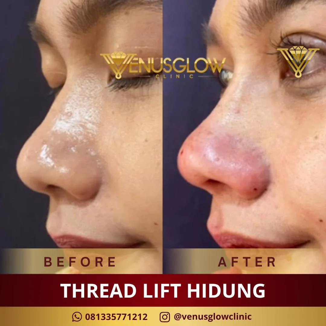 Nose Thread
