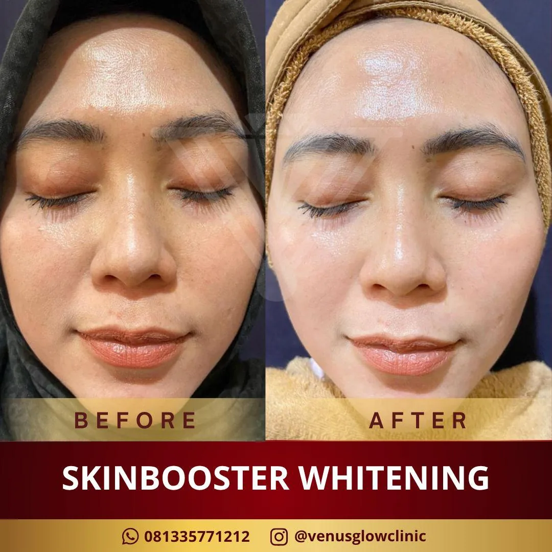 Before & after — Skinbooster — Whitening